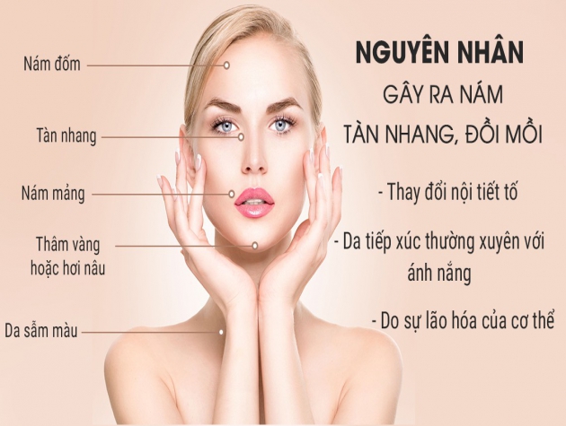 Tàn nhang nám cũng phải “chào thua” khi bạn dùng tuyệt chiêu này